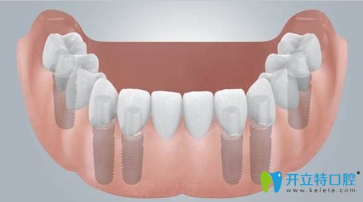 顧騰飛醫(yī)生科普無牙頜全口義齒修復(fù)技術(shù)