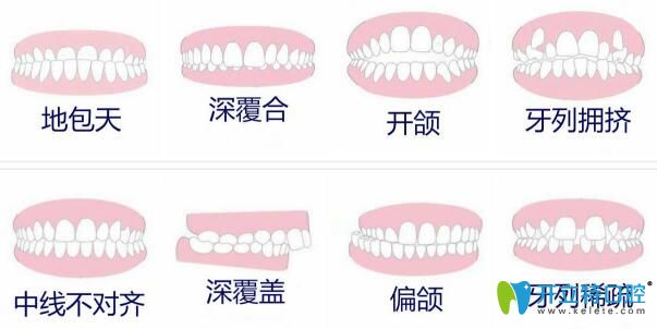 牙齒矯正適應(yīng)人群