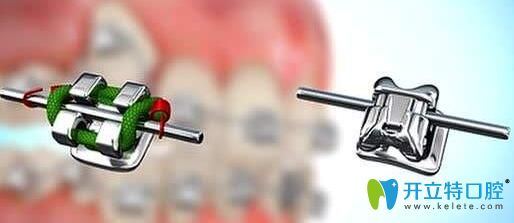 自鎖托槽和普通托槽對(duì)比圖