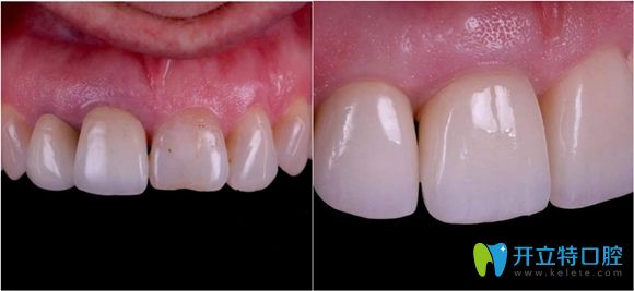 深圳福田區(qū)佳美口腔門牙種植術后效果圖