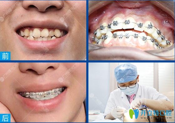 曙光牙科牙齒不齊矯正案例前后對(duì)比圖