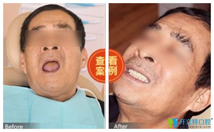 西安中諾顧客全口牙種植前后對(duì)比圖