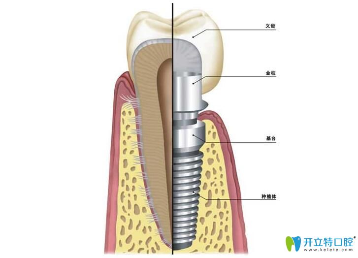 恒美口腔對于種植體、基臺和牙冠的要求很高