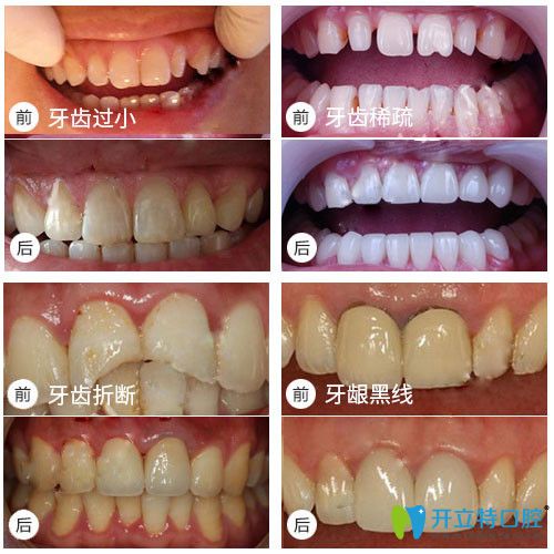 銘德口腔牙齒修復(fù)前后對比效果