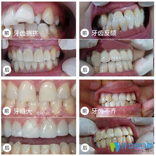牙齒擁擠/牙齒不齊矯正等前后對比照