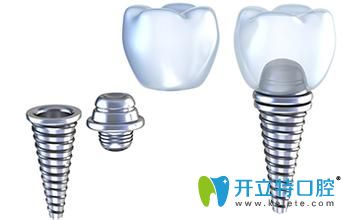 德國ankylos種植系統(tǒng)特點