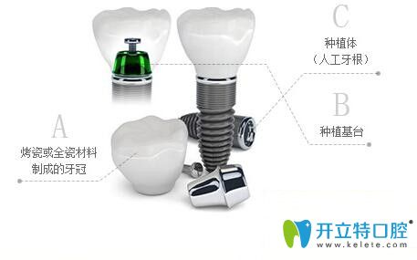 種植牙介紹圖