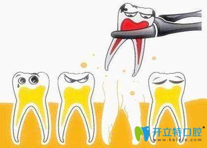 牙齒松動要拔牙嗎