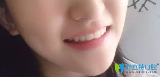 牙齒歪斜矯正后的照片