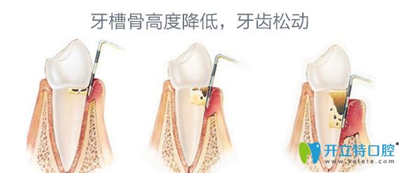 牙周病牙齒松動