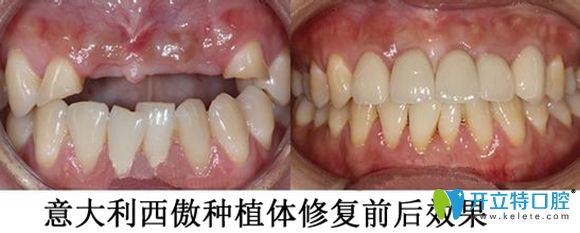 西傲種植系統(tǒng)還可抑制骨吸收