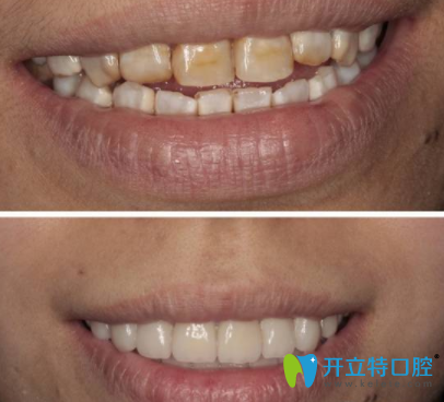 氟斑牙美白前后對(duì)比照