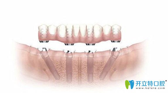 即刻種植牙當(dāng)天就能吃東西？