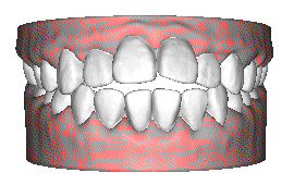 牙齒矯正并不是越快越好 牙齒矯正并不是越快越好