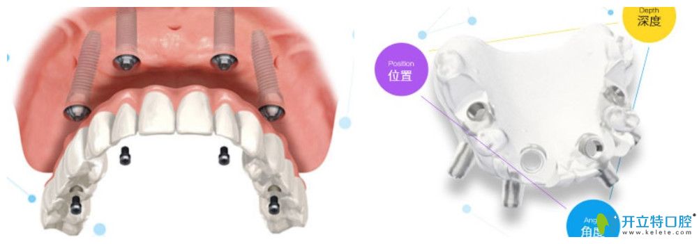 杭州美奧口腔的種植牙技術