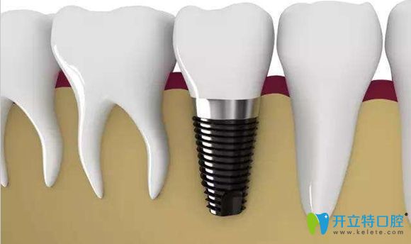 僑諾口腔有多種種植牙品牌可供選擇 僑諾口腔有多種種植牙品牌可供選擇