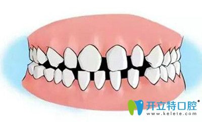 以親身經(jīng)歷告知大家牙間隙過大有哪些危害以及治療方法