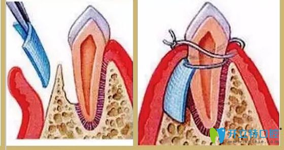 種植牙齒什么情況下需要填骨粉