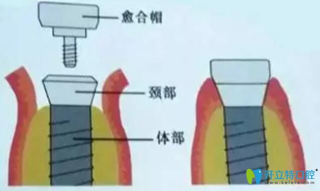 非埋入式種植牙