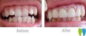 希諾爾隱形矯正案例