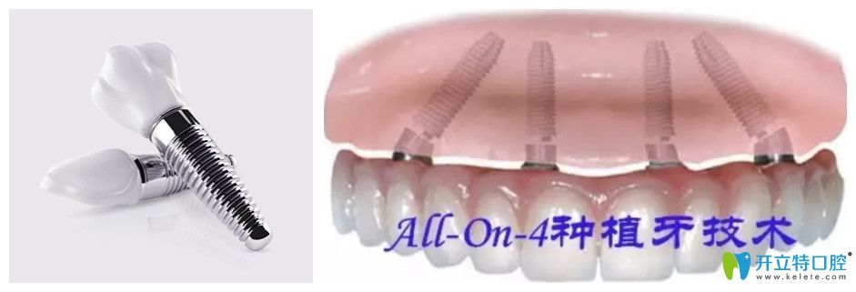 美奧口腔allon4半口牙種植價(jià)格圖