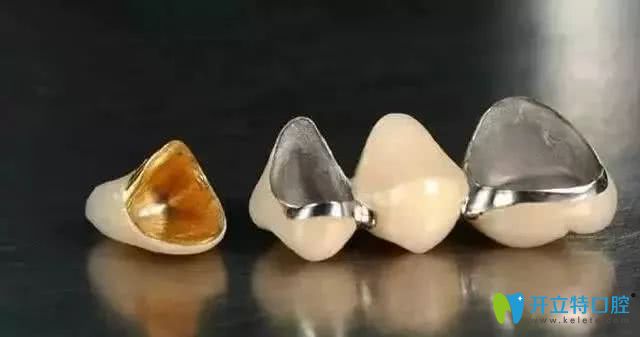 烤瓷牙的效果圖 烤瓷牙的效果圖