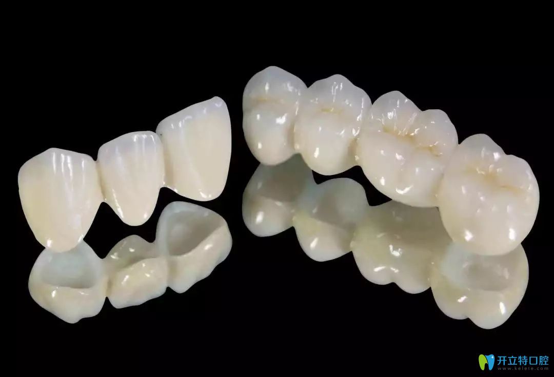 全瓷牙的圖片 全瓷牙的圖片