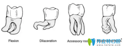 阻生牙根部形態(tài)