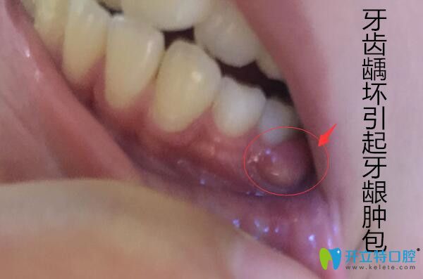 牙齒齲壞引起牙齦腫包