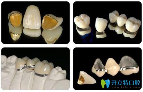 全冠牙套的圖片