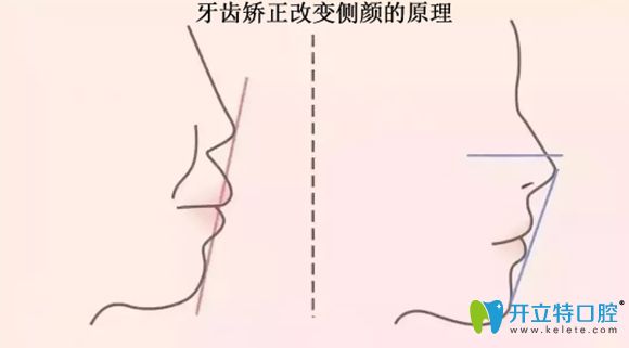 牙齒矯正改善側(cè)顏的原理圖