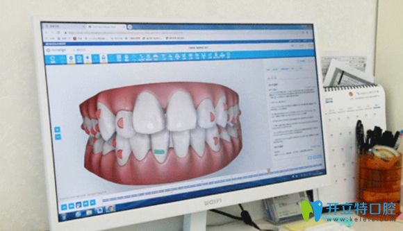 美奧口腔隱形牙齒矯正宣傳圖