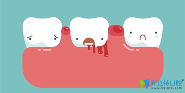 種植牙無需磨損臨近好牙