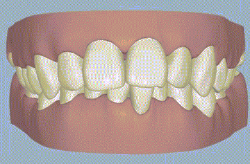牙齒矯正牙齒移動圖片