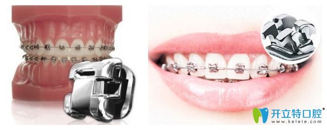 奧美科自鎖矯正與3m金屬自鎖矯正價(jià)格