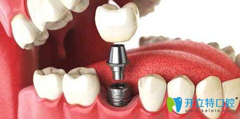 種植牙介紹圖