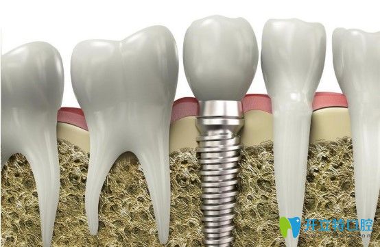 汪醫(yī)生科普種植牙 汪醫(yī)生科普種植牙