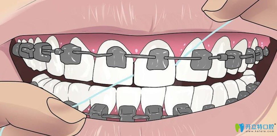 半隱形牙齒矯正利弊
