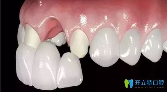 只有一兩顆烤瓷牙，還是可以考慮進(jìn)行牙齒矯正的