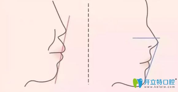 牙齒牙頜前突矯正前后對比圖