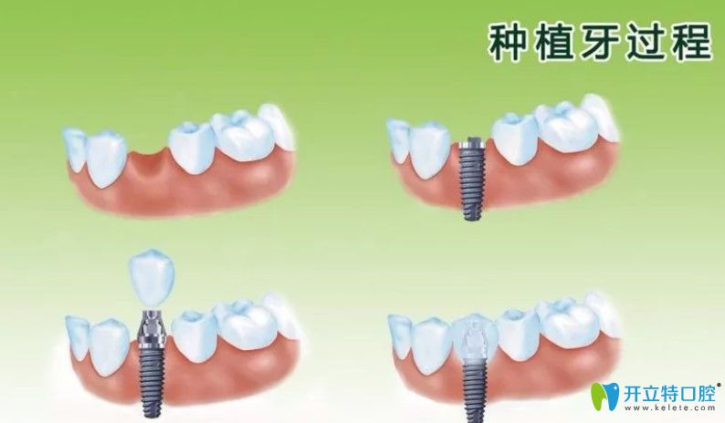 種植牙過程圖示