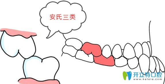 安氏三類錯頜癥狀示意圖