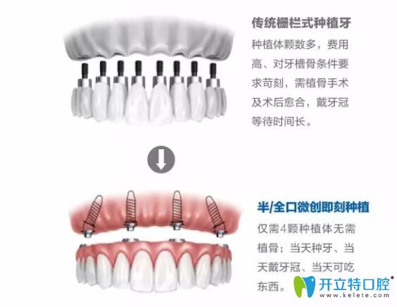 即刻種植優(yōu)勢(shì)