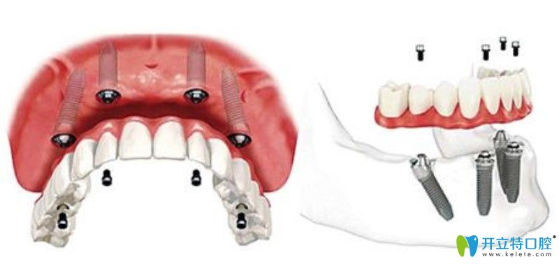 陳貞醫(yī)生建議全口牙缺失還是做種植牙好 陳貞醫(yī)生建議全口牙缺失還是做種植牙好