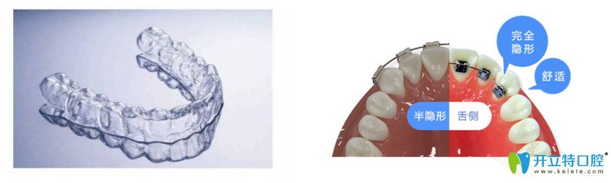 隱形矯正和舌側(cè)隱形矯正