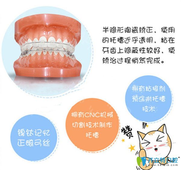 陶瓷托槽半隱形矯正優(yōu)勢(shì)