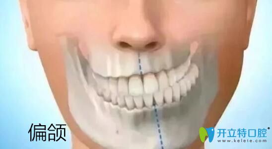牙頜畸形之偏頜圖片