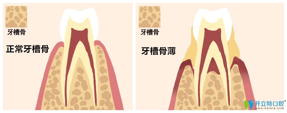 什么是牙周翻瓣植骨手術(shù)