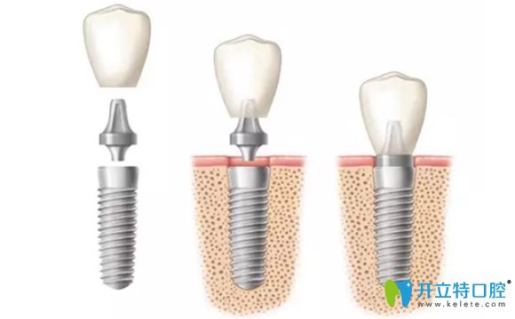 韓國登特斯種植牙示意圖