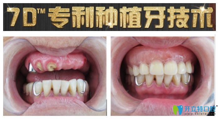 重慶團圓口腔半口種植牙